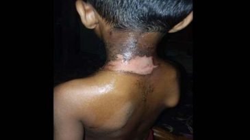 জৈন্তাপুরে শিশুর শরীর ঝলসে দিলেন মক্তবের শিক্ষক