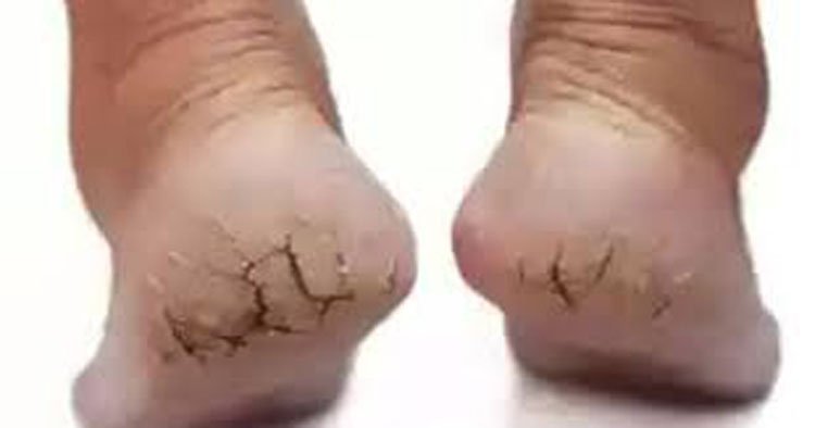 শীতে পা ফাটা রোধ করতে যা করবেন