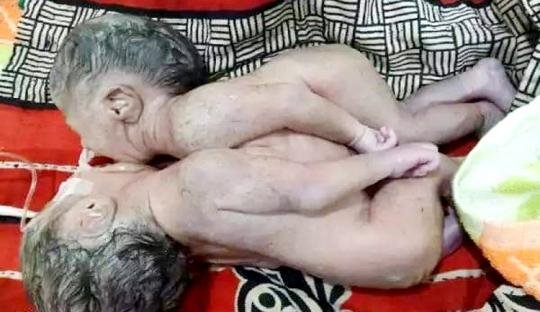 মৃত্যুর কাছে হেরে গেল জোড়া লাগা দুই শিশু