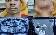 কিশোরের মুখ থেকে তোলা হলো ৮২টি দাঁত!