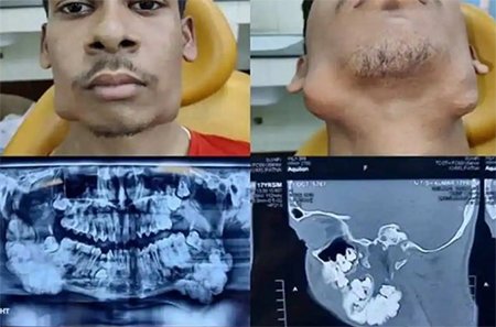 কিশোরের মুখ থেকে তোলা হলো ৮২টি দাঁত!