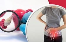 নারীর ডিম্বাশয়ে ক্যানসারের যেসব লক্ষণ