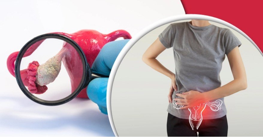 নারীর ডিম্বাশয়ে ক্যানসারের যেসব লক্ষণ