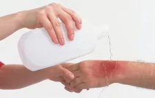 পুড়ে গেলে কী করবেন