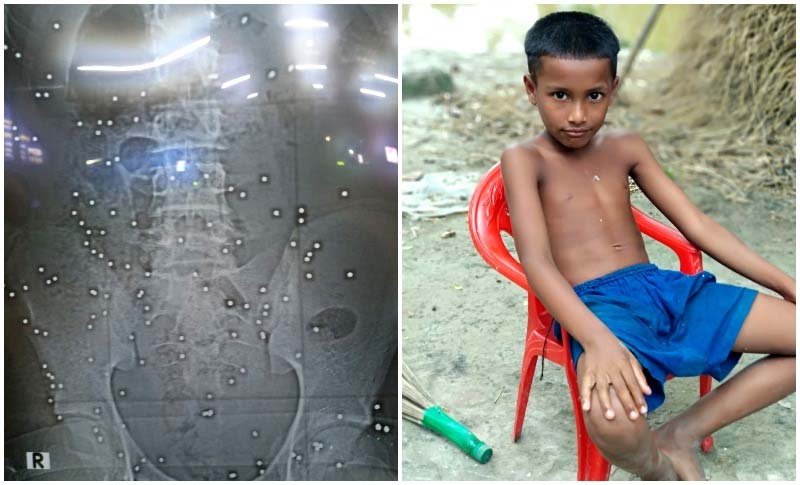 শরীরে শত শত স্প্লিন্টার, হাসপাতালে কাতরাচ্ছে শিশু তফাজ্জল