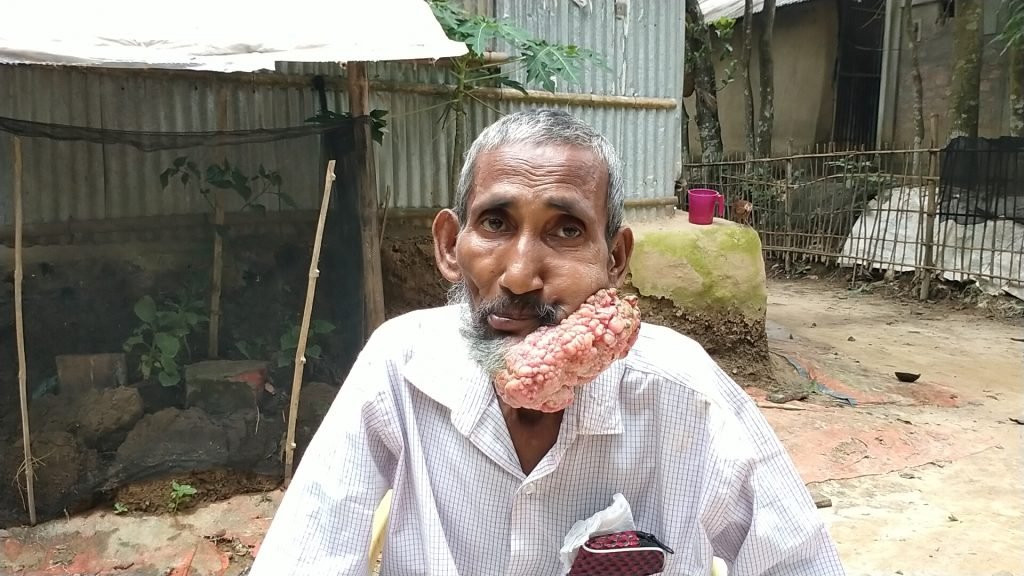 কমলগঞ্জে বিরল রোগে আক্রান্ত বৃদ্ধের বেচেঁ থাকার আকুতি