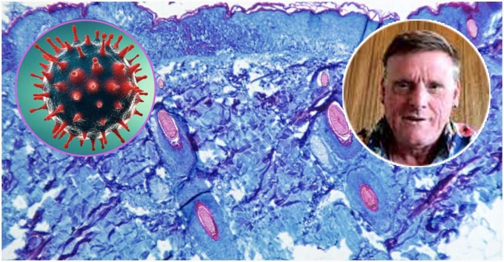 বিশ্বে প্রথম একই সময়ে করোনা-মাঙ্কিপক্সে আক্রান্ত রোগী শনাক্ত