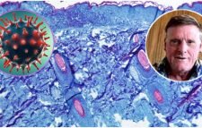 বিশ্বে প্রথম একই সময়ে করোনা-মাঙ্কিপক্সে আক্রান্ত রোগী শনাক্ত