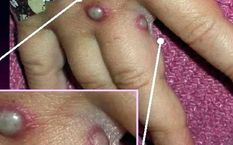 এশিয়া ইউরোপসহ বিভিন্ন দেশে ছড়িয়ে পড়ছে এমপক্স